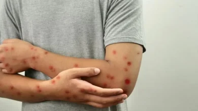 Photo of Anvisa determina ações de orientação sobre mpox e sarampo em portos, aeroportos e voos