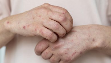 Photo of Segundo Ministério da Saúde, Mpox não é motivo de alerta