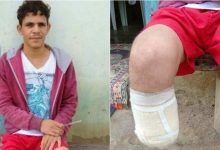 Photo of Pé amputado por servidor para fraudar seguro foi encontrado dentro de mochila